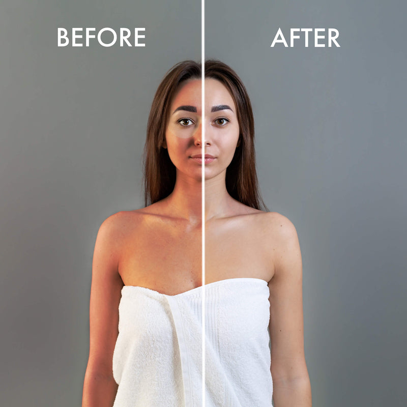 Image Taken Using LUMI400II Medical Clinical Aesthetic Photography Studio Flash Kit (Before and After)